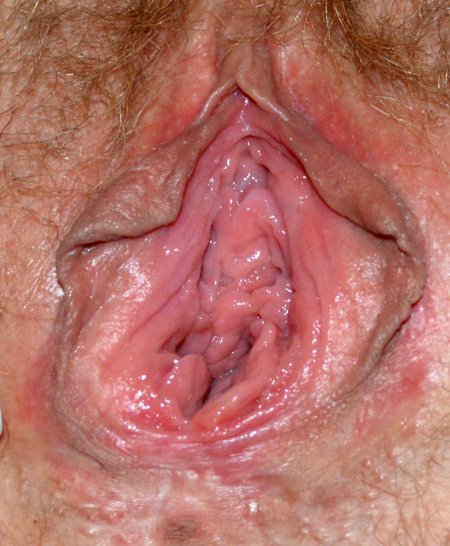 Остроконечные кондиломы