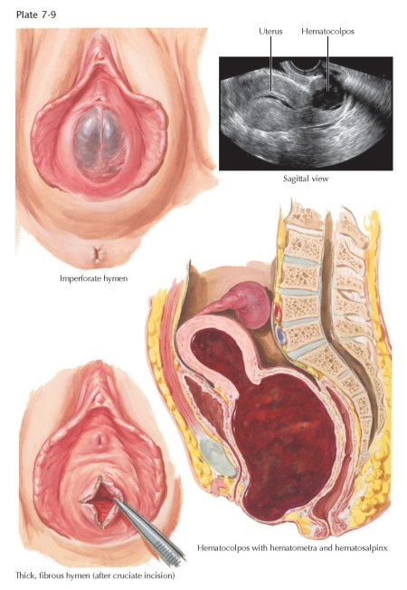 Полулунная девственная плева
