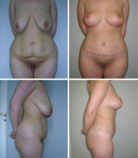 Абдоминопластика живота рубец