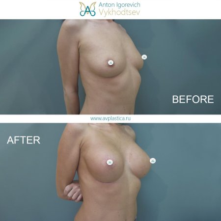 Увеличение груди анатомическими имплантами