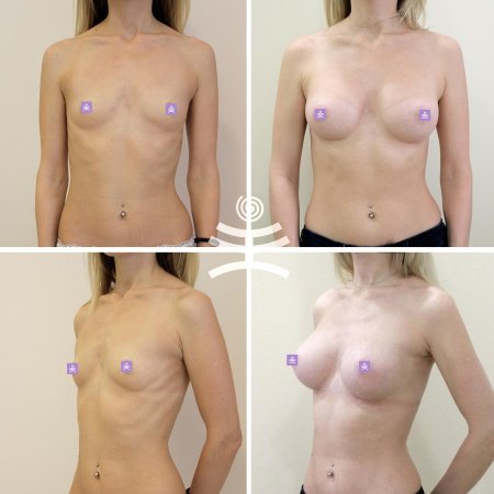 Анатомические импланты