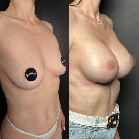 Маммопластика до и после
