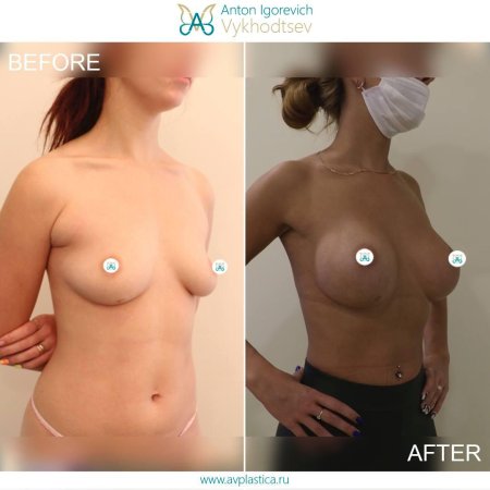 До и после увеличения груди