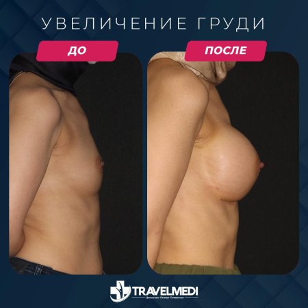 Грудь после увеличения имплантами
