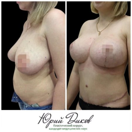 Пластика груди