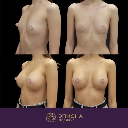 Пластика груди анатомические импланты