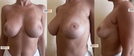 Редукционная маммопластика