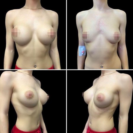 Маммопластика до и после