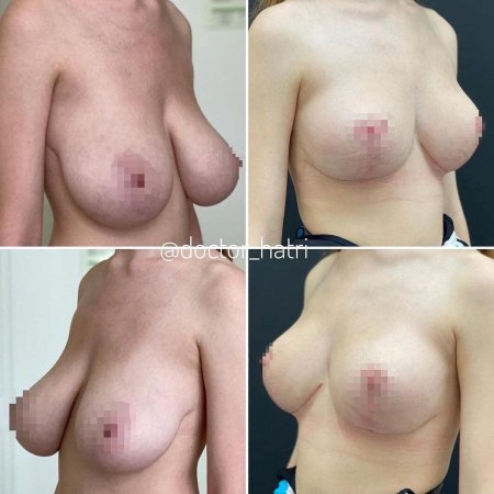 До и после увеличения груди