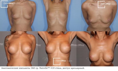 Грудь пластика