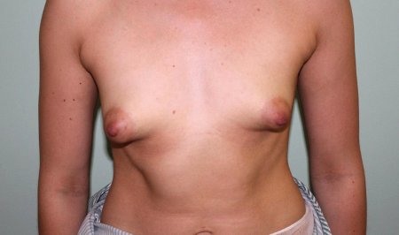 3. гинекомастия