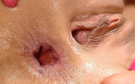 Анал фистинг