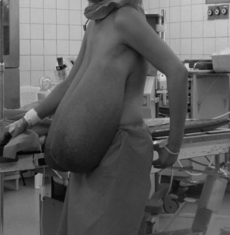 Макромастия у девочек подростков