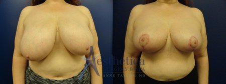 Подтяжка груди