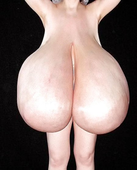 Огромные сиськи макромастия