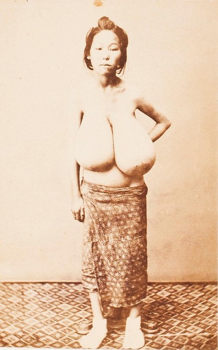 Гипермастия макромастия