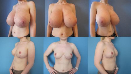 Breast augmentation