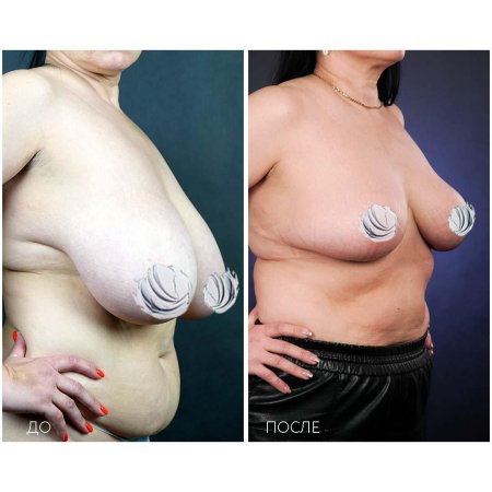 Операции по уменьшению груди