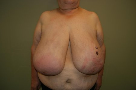 Гипермастия макромастия