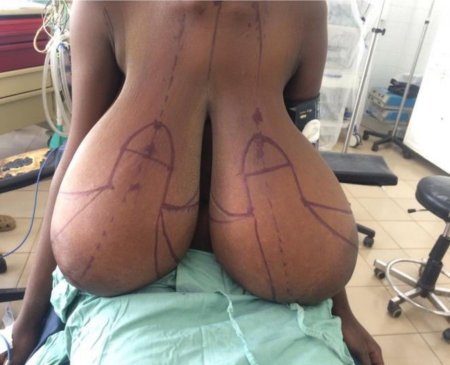 Гигантомастия у женщин