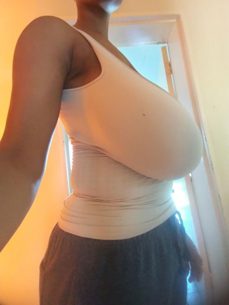 Гигантомастия патология