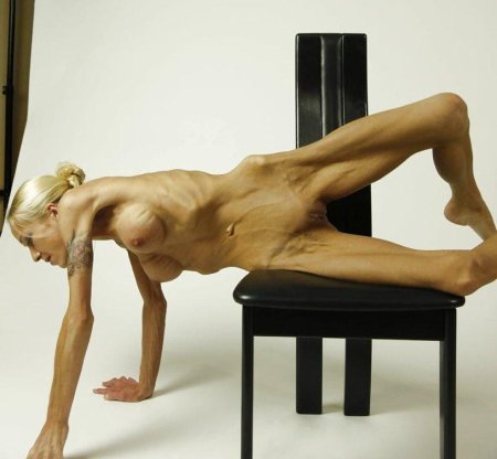 Девушка с анорексией