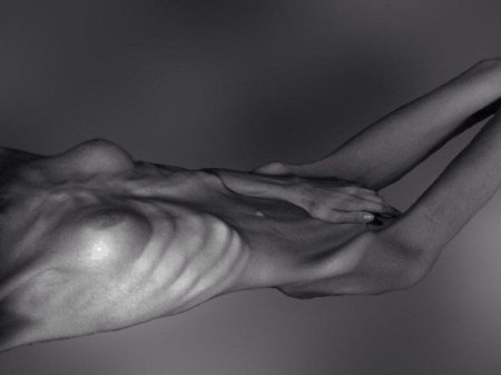 Кахексия и анорексия