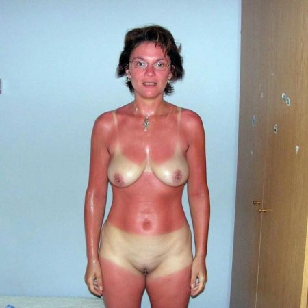 Ожоги от загара