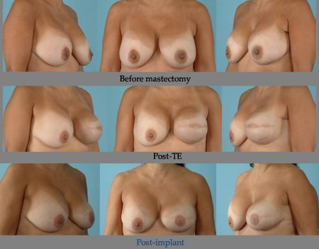 Увеличение груди