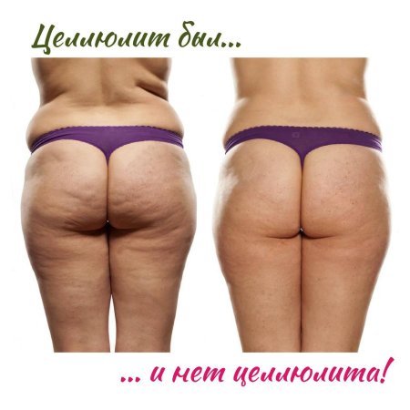 Целлюлит на попе