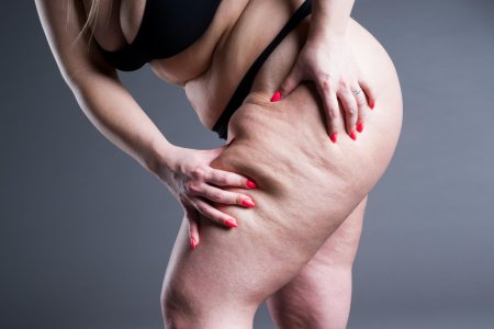 Женщина с целлюлитом