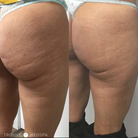 До и после антицеллюлитного массажа