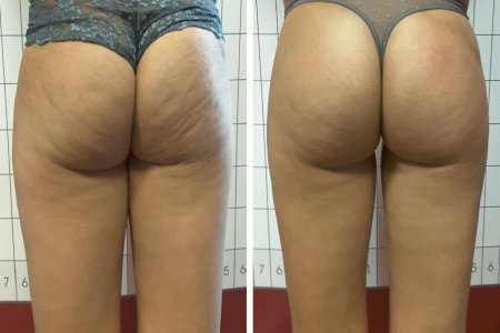 Антицеллюлитный массаж до и после