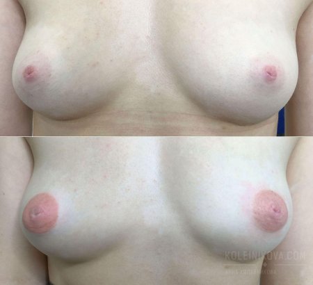 Женская грудь без ореолов