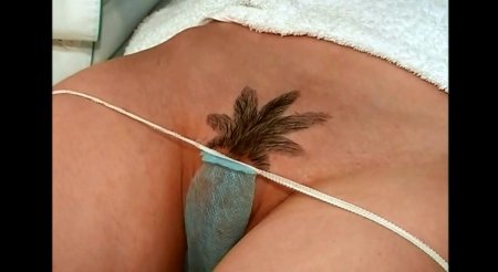 Интимная депиляция
