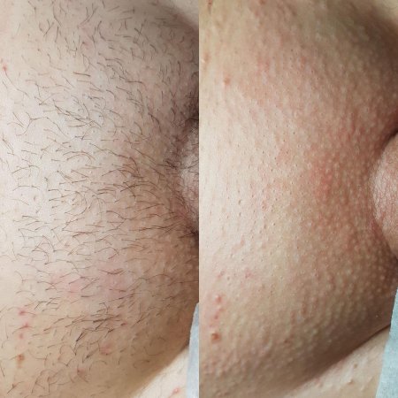 Лазерная эпиляция глубокого бикини