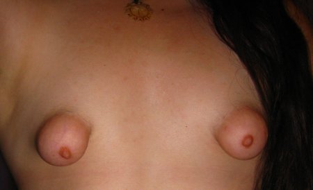 Некрасивая грудь