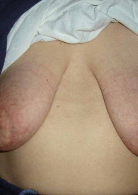 Уродливые сиськи