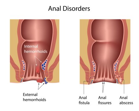 Internal hemorrhoids