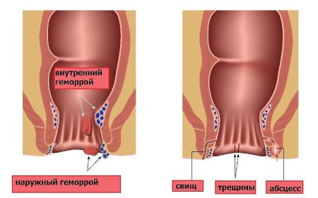 Наружный и внутренний геморрой