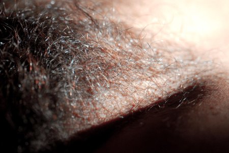 Лобковые волосы у женщин