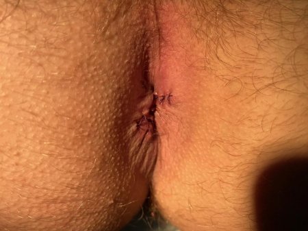 Геморрой анал