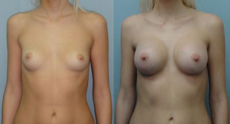 Увеличение груди