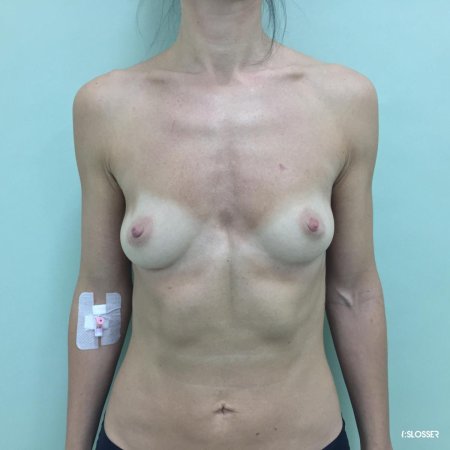 Асимметрия груди у женщин