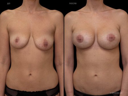 Подтяжка груди