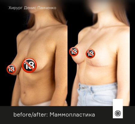 Асимметрия женской груди