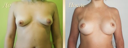 Асимметрия груди у женщин