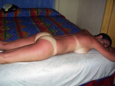 Обгорела на солнце частное ню