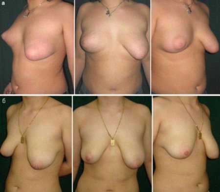 Для увеличения груди