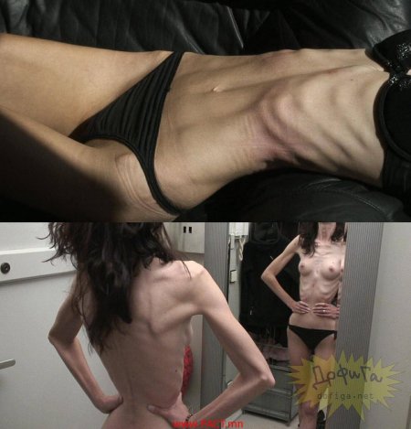 Больные анорексией